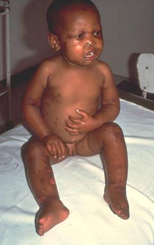 Child with bilateral oedema, skin and hair changes
